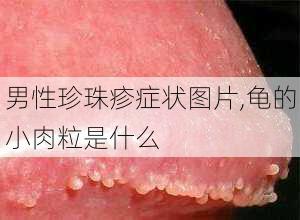 男性珍珠疹症状图片,龟的小肉粒是什么