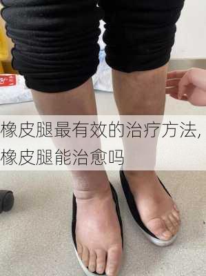 橡皮腿最有效的治疗方法,橡皮腿能治愈吗